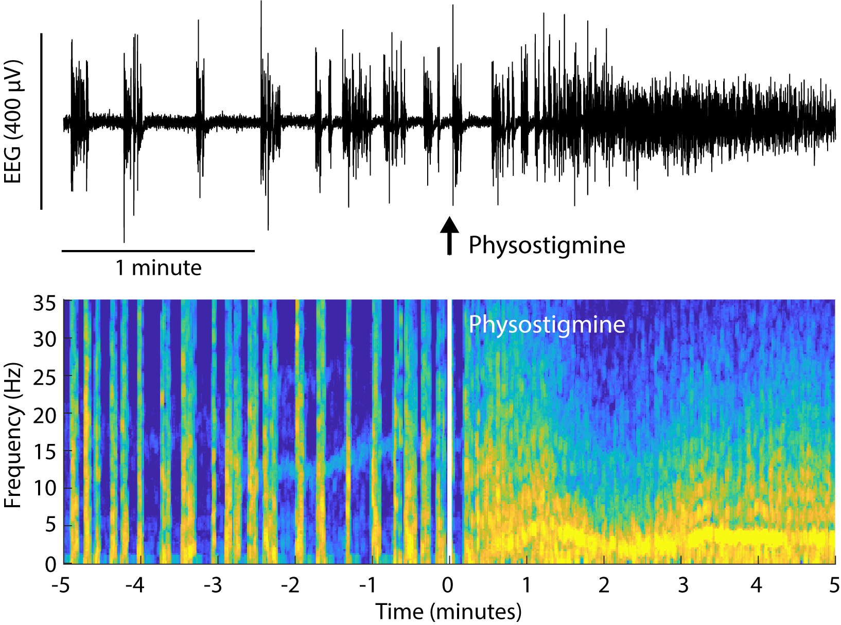 Administration of physostigmine causes emergence from a burst-suppression pattern that was induced by isoflurane general anesthesia.